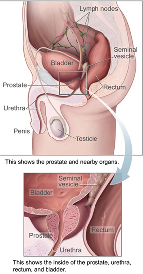 Clinical diagram showing prostate gland location relative to bladder and urethra